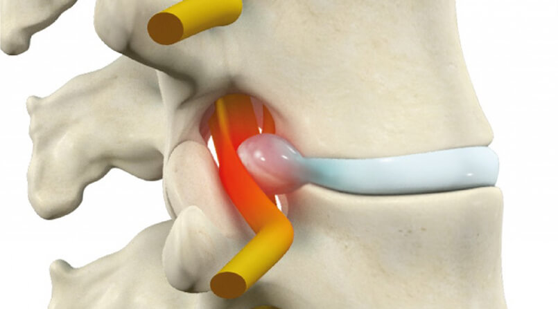 Hérnia de Disco: O que é, Causas, Sintomas e TratamentosHérnia de Disco