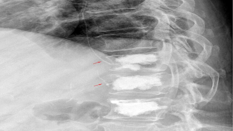 Cifoplastia