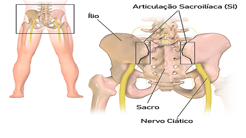 Infiltrações na articulação sacroilíaca 