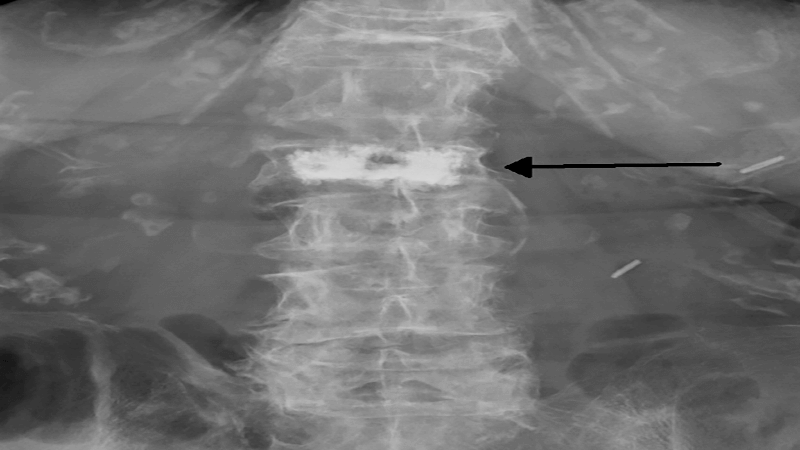 Vertebroplastia 