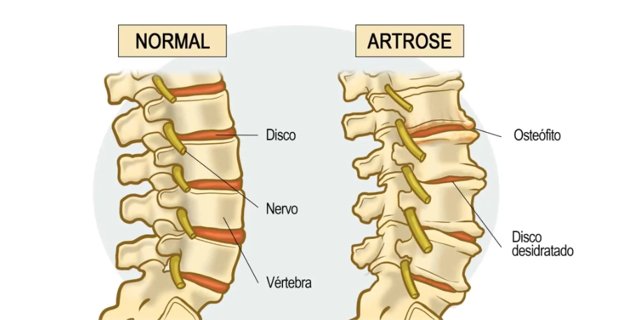 Dor nas costas: o que é dor lombar ou lombalgia? 7