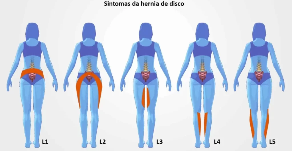 Dor nas costas: o que é dor lombar ou lombalgia? 8