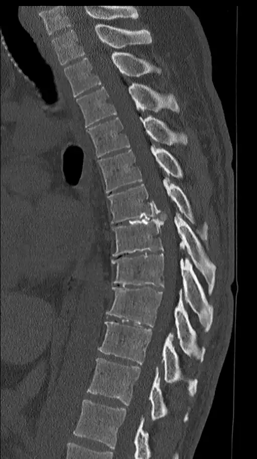 Exame de tomografia computadorizada da coluna vertebral mostrando a presença de uma hérnia de disco.