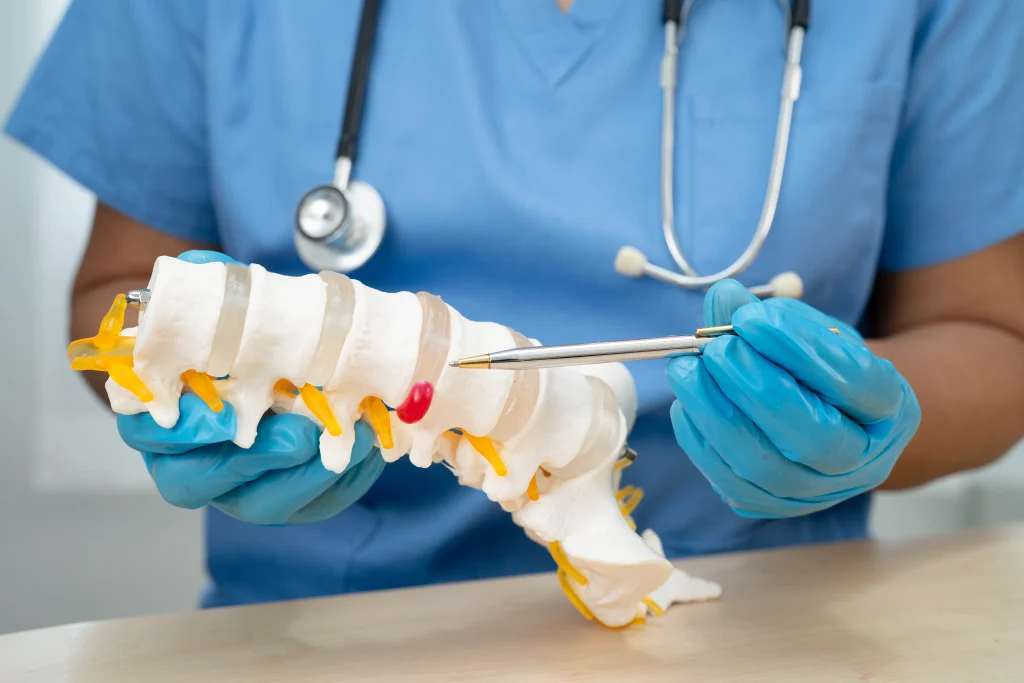 Profissional de saúde aponta com uma caneta para a compressão nervosa em um modelo de hérnia de disco.